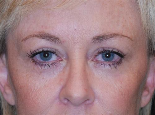 Eyelid Surgery Case 4