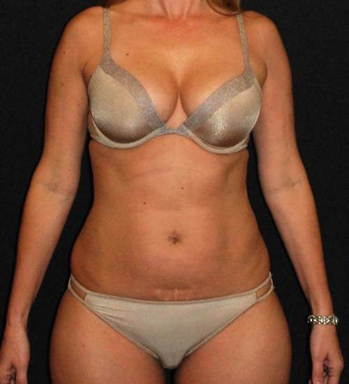 Tummy Tuck & Liposuction Case 42