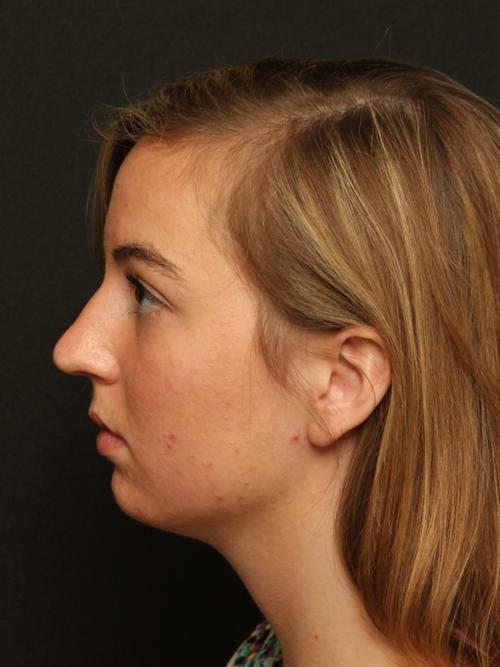 Rhinoplasty & Chin Implant Case 52