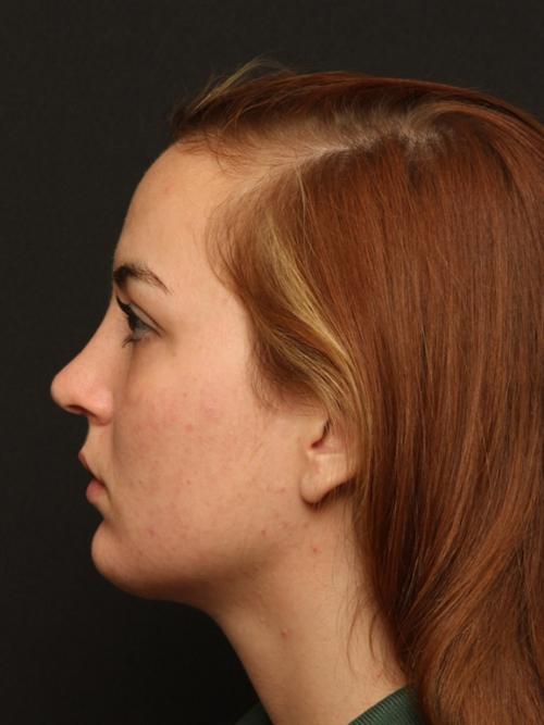 Rhinoplasty & Chin Implant Case 52