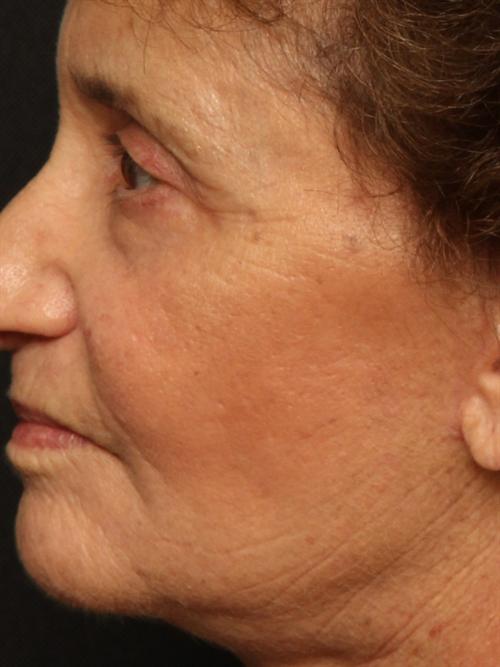 Laser Skin Resurfacing Case 53