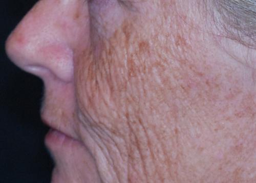 Laser Skin Resurfacing Case 6