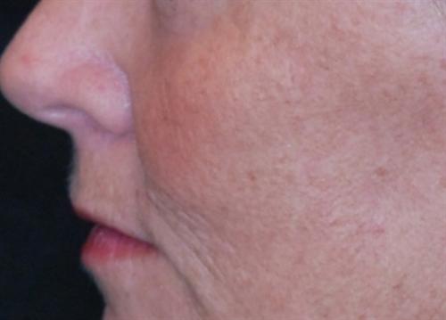 Laser Skin Resurfacing Case 6