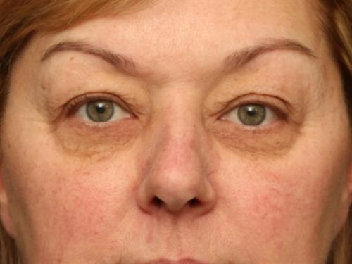 Eyelid Surgery Case 63