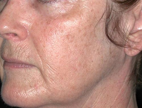 Laser Skin Resurfacing Case 7