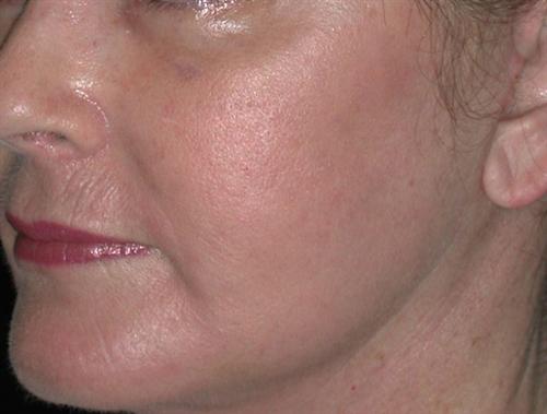 Laser Skin Resurfacing Case 7