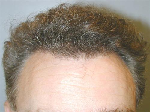 Hair Restoration Case 73
