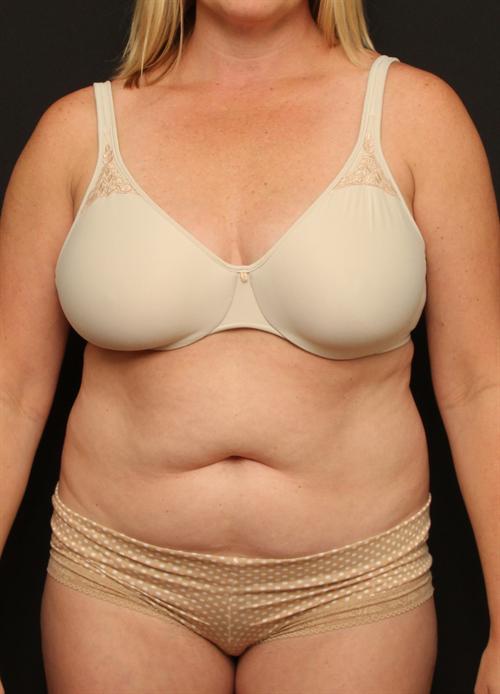 Tummy Tuck & Liposuction Case 90