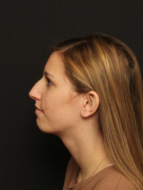 Rhinoplasty Case 93