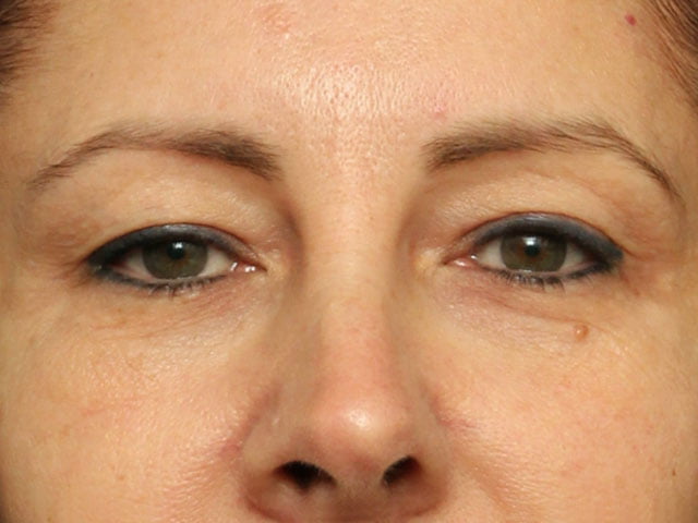 Eyelid Surgery Case 18238