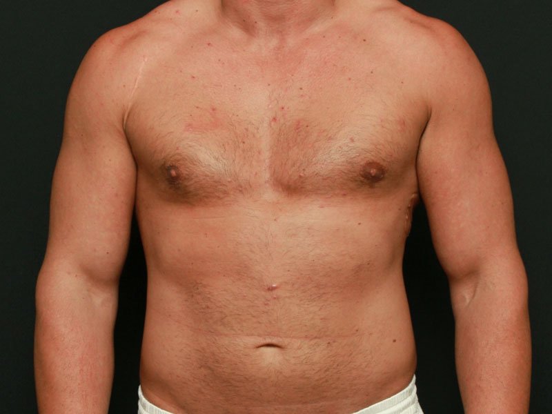 Male Chest Reduction 18222