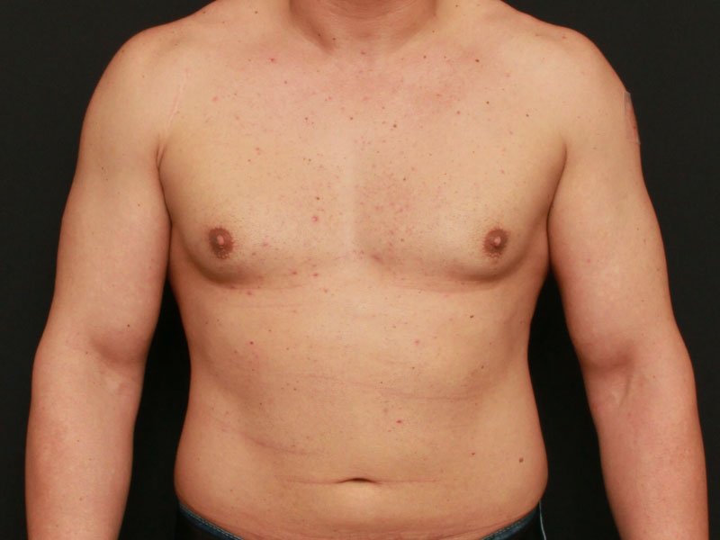 Male Chest Reduction 18222