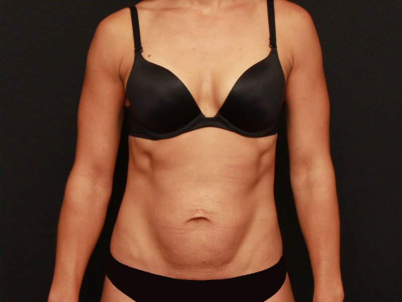 Tummy Tuck Case 18058