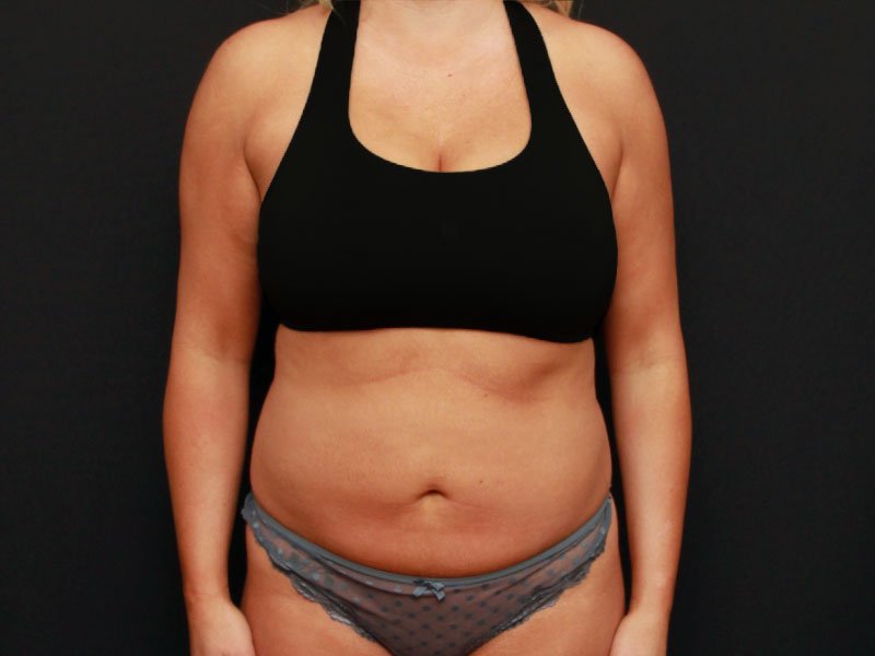 Mini Tummy Tuck and Liposuction Case 18214