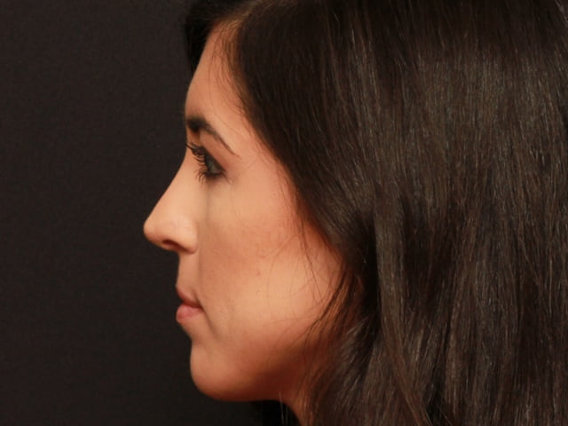 Rhinoplasty Case 18427