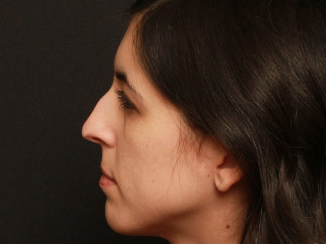 Rhinoplasty Case 18427