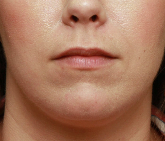 Lip Enhancement Case 18567