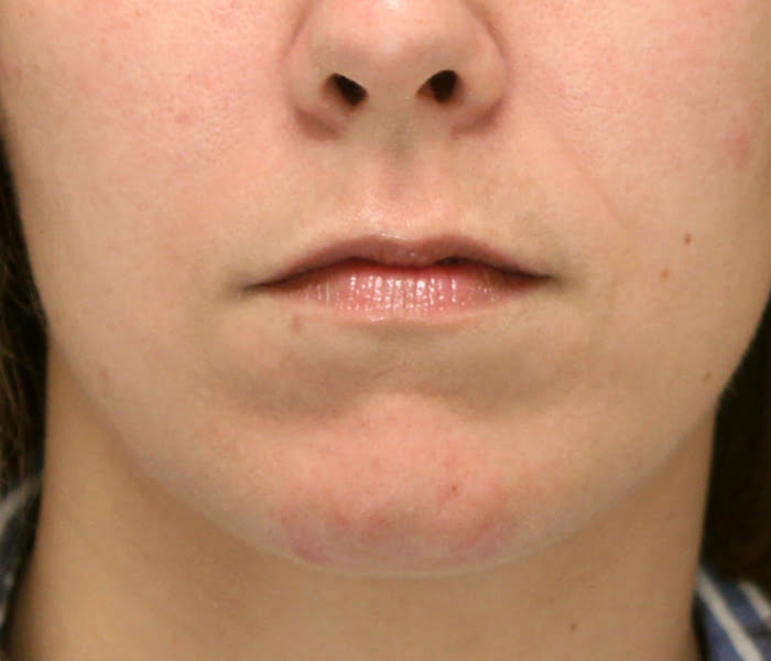 Lip Enhancement Case 18567