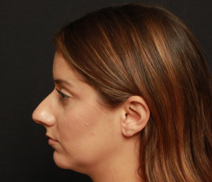 Rhinoplasty and Chin Augmentation Case 18554