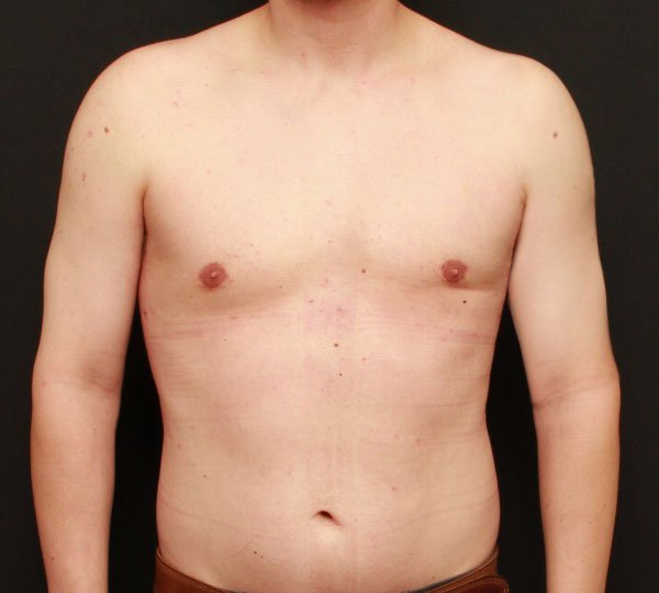 Male Chest Reduction 19607