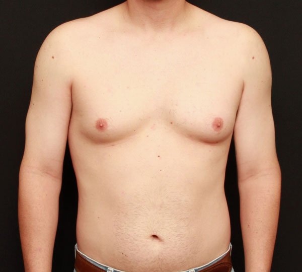 Male Chest Reduction 19607