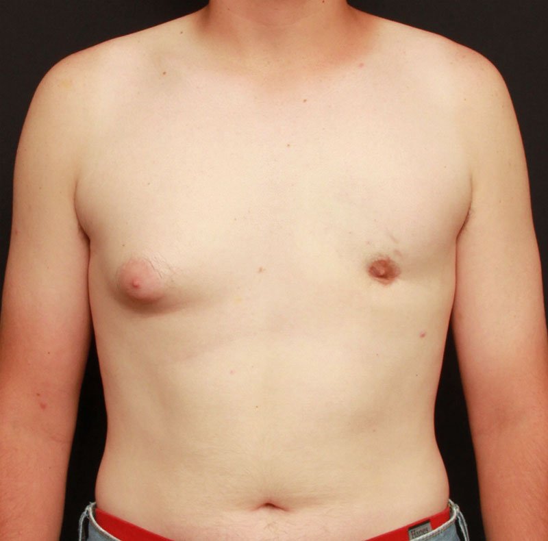 Male Chest Reduction 20902