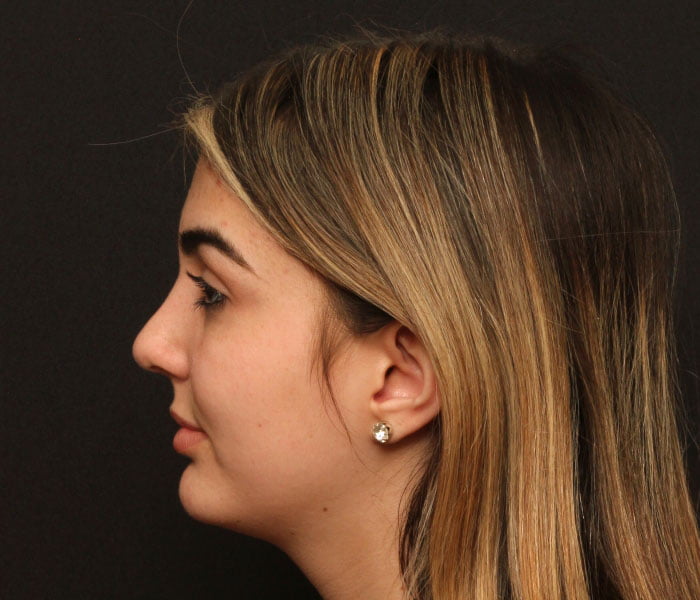 Rhinoplasty Case 21496