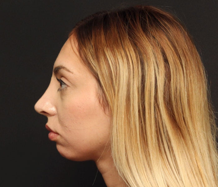 Rhinoplasty Case 21522