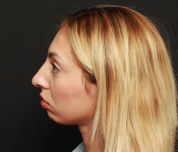 Rhinoplasty Case 21522