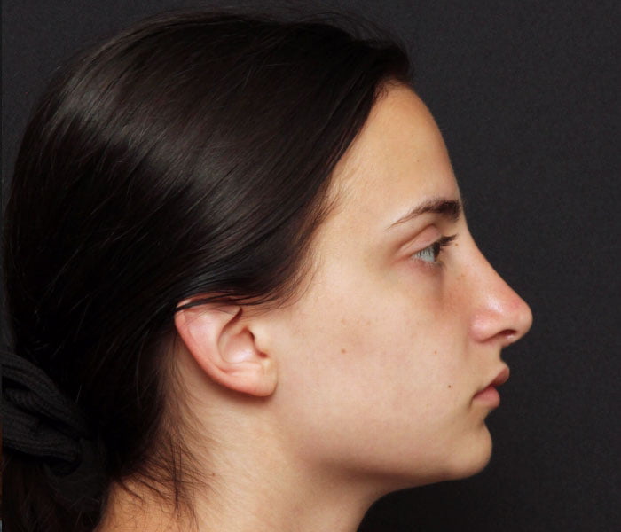 Rhinoplasty Case 21769