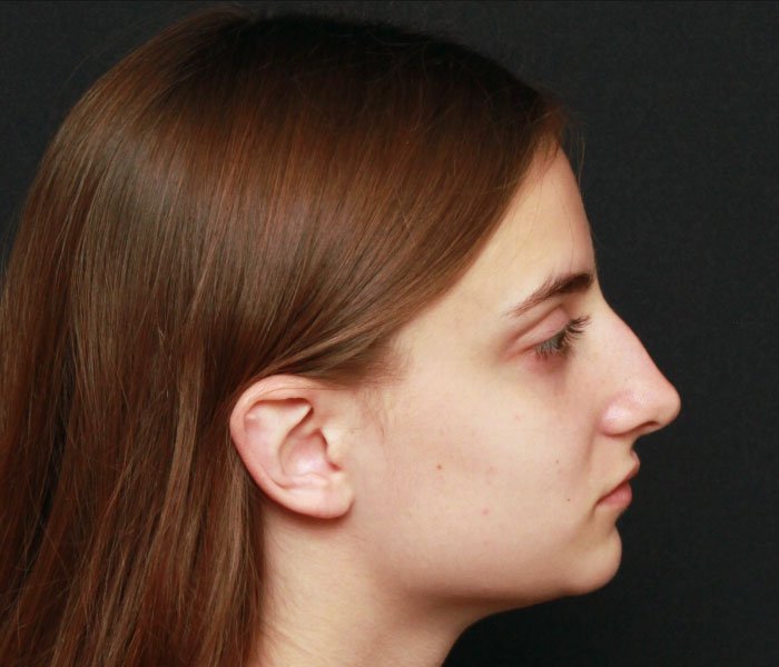 Rhinoplasty Case 21769