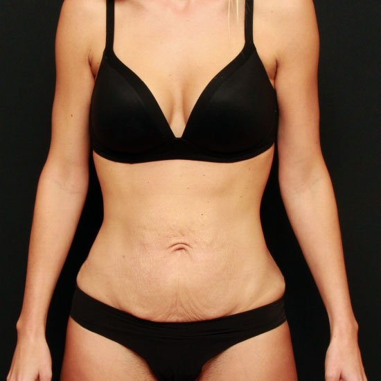 Tummy Tuck with Liposuction Case 22040