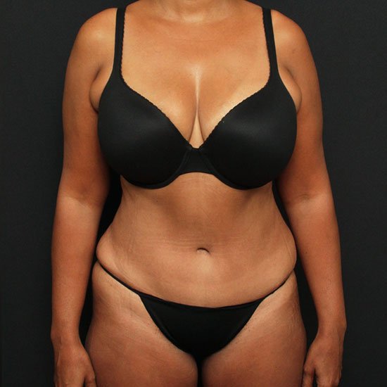 Tummy Tuck with Liposuction Case 23178