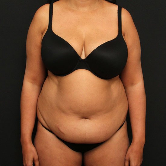Tummy Tuck with Liposuction Case 23178