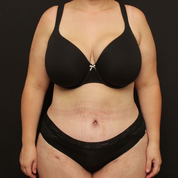 Tummy Tuck with Liposuction Case 24041