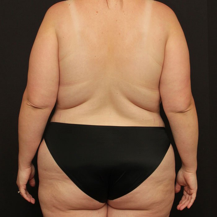 Liposuction and Renuvion Case 24044