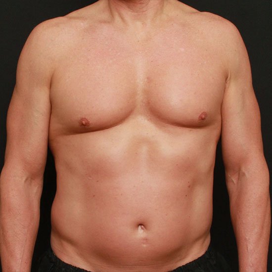 Liposuction and Renuvion Case 24213