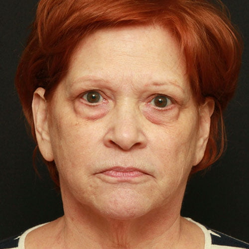 Facial Rejuvenation Case 24570