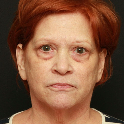 Facial Rejuvenation Case 24570