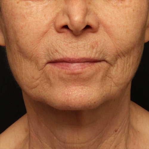 Chin Implant Lip Lift CO2 Lasers Case 24348