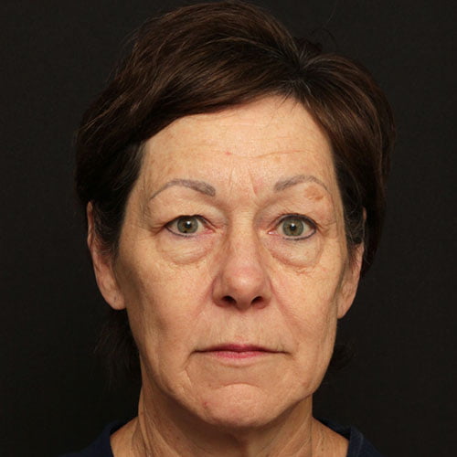 Facial Rejuvenation Case 24689
