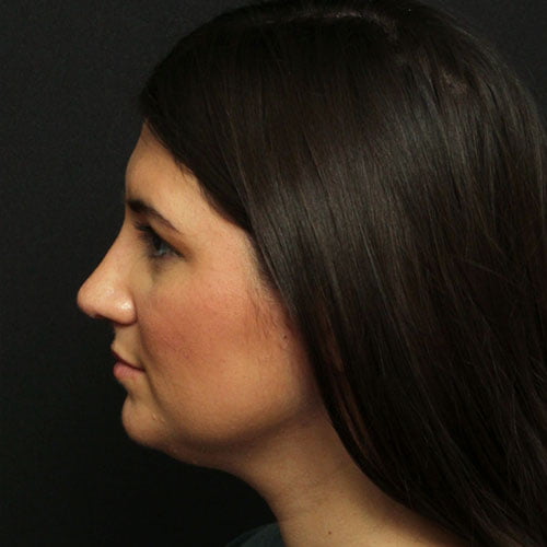 Rhinoplasty Case 24530