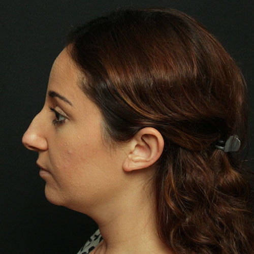 Rhinoplasty Case 24537