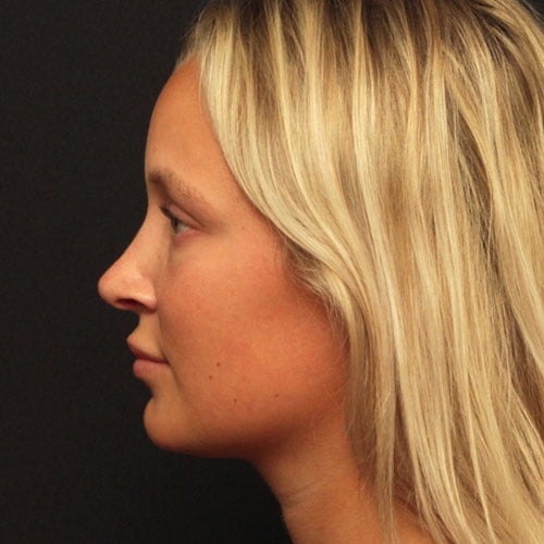 Rhinoplasty Case 24581