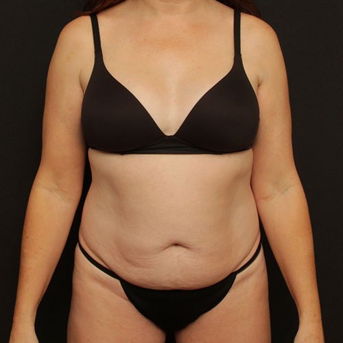 Tummy Tuck with Liposuction Case 24514