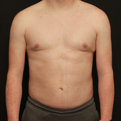 Liposuction and Renuvion Case 24764