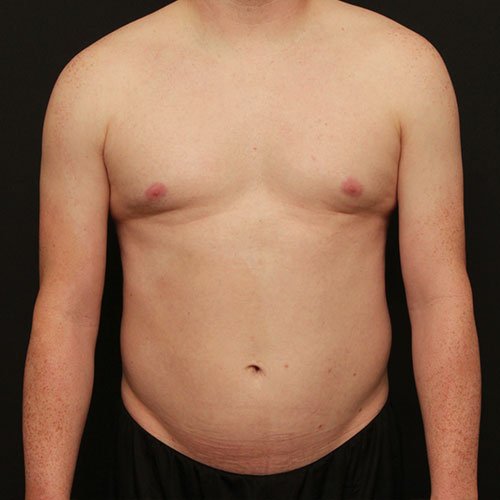 Liposuction and Renuvion Case 24764
