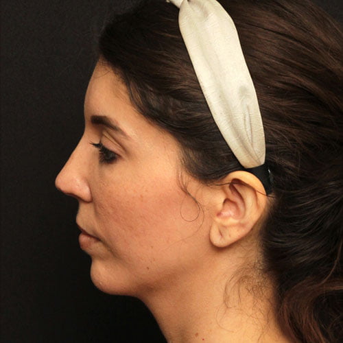 Rhinoplasty Case 25247