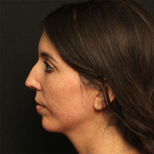 Rhinoplasty Case 25247