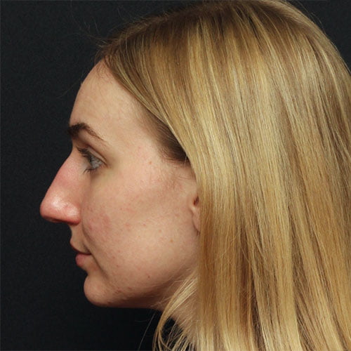 Rhinoplasty Case 25259